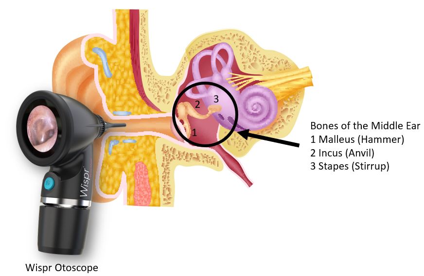Hammer, Anvil & Stirrup by otoscopy. Bones of the middle ear